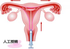 哪些人适合做日本试管婴儿人工授精手术治疗？