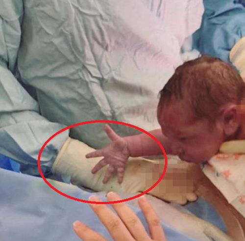 13岁女孩挤痘痘诱发败血症 13岁女孩挤痘痘诱发败血症