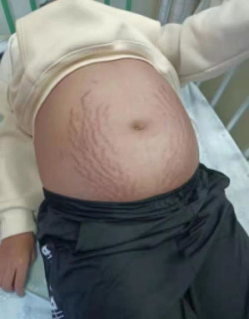 第三代试管婴儿操作流程步骤是哪些