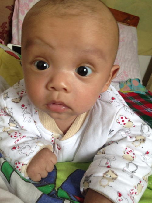 婴儿血管瘤的发病原因是什么