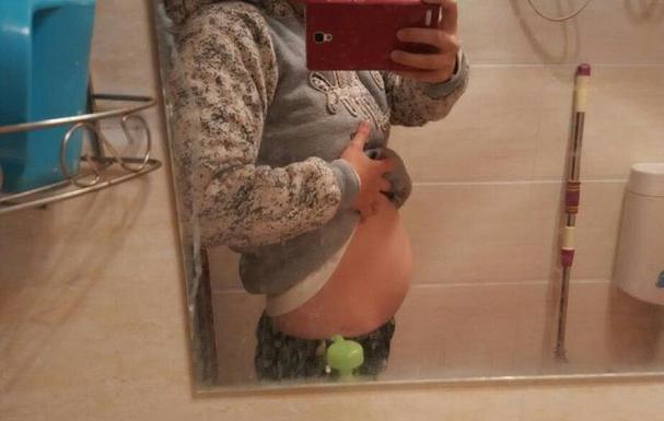 婴儿脐疝怎么治疗 婴儿脐疝怎么治疗